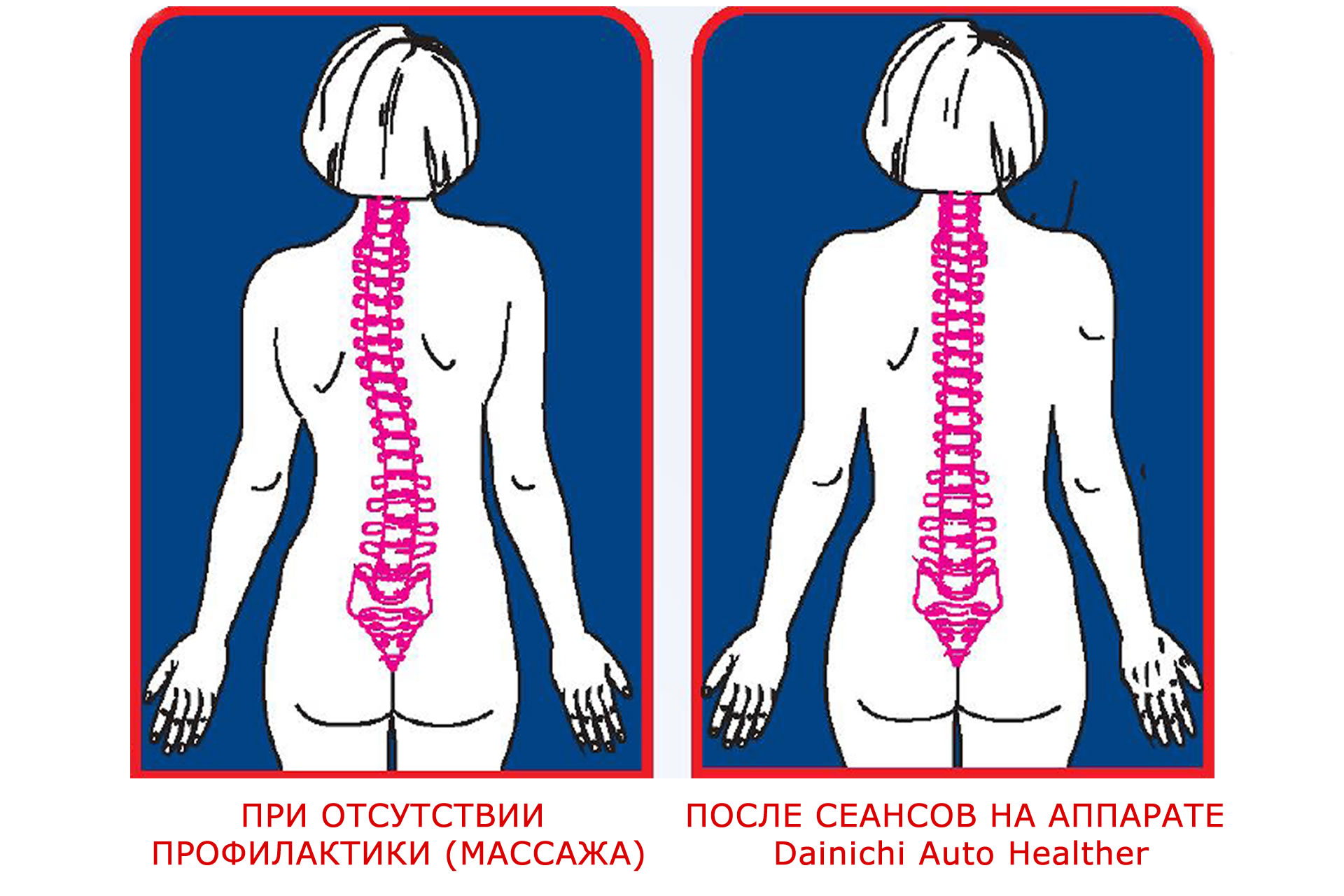 Массажная программа для детей при нарушении осанки и сколиозе 1 и 2 степени
